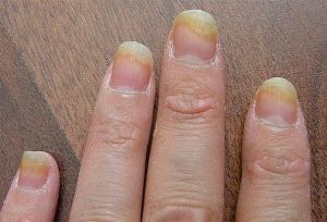 Fingernails Fungus